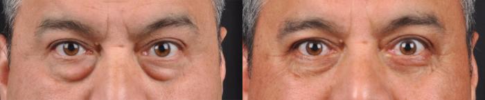 Before & After Eyelid Surgery Case 60629 Front View in Virginia Beach, VA