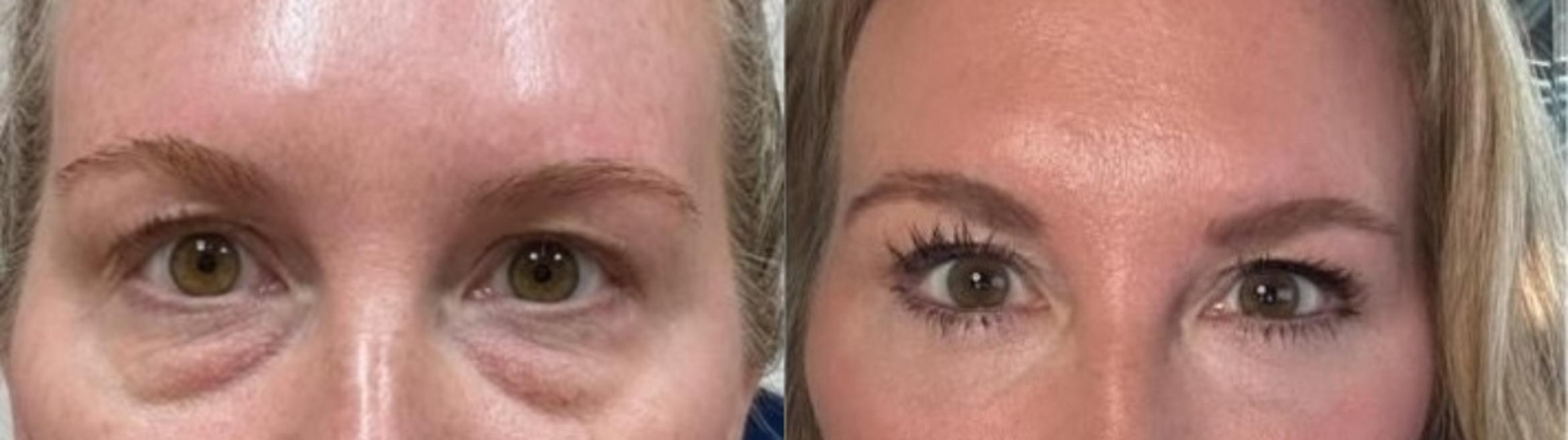 Before & After Eyelid Surgery Case 60631 Front View in Virginia Beach, VA