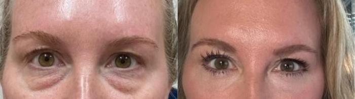 Before & After Eyelid Surgery Case 60631 Front View in Virginia Beach, VA