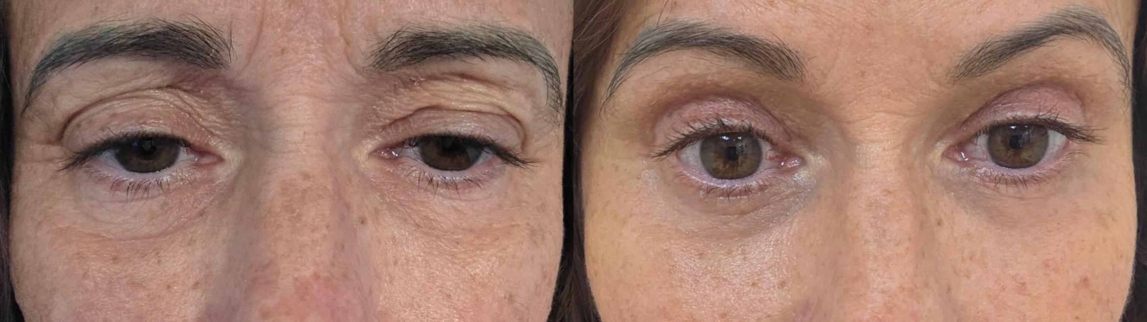 Before & After Eyelid Surgery Case 60634 Front View in Virginia Beach, VA