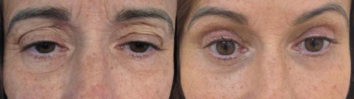 Before & After Eyelid Surgery Case 60634 Front View in Virginia Beach, VA