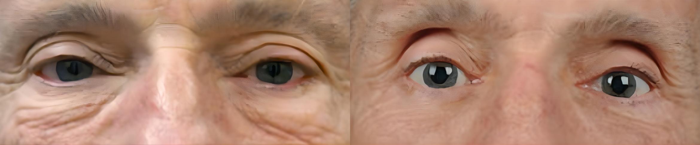 Before & After Eyelid Surgery Case 60636 Eyes View in Virginia Beach, VA