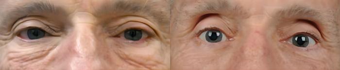 Before & After Eyelid Surgery Case 60636 Eyes View in Virginia Beach, VA