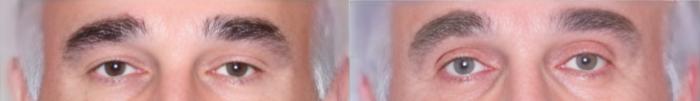 Before & After Eyelid Surgery Case 60637 Eyes View in Virginia Beach, VA