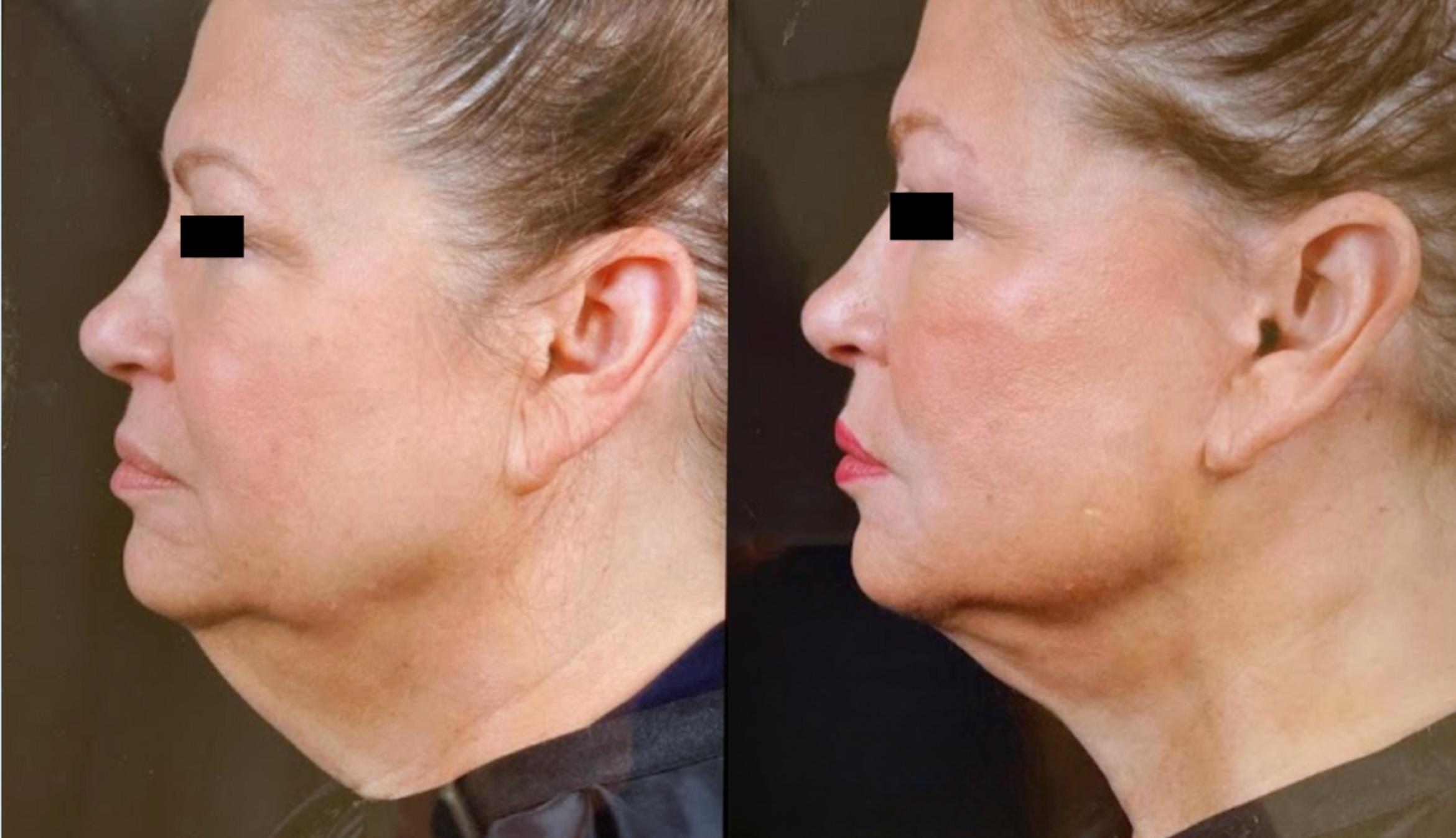Before & After Facelift Case 14 View 1 View in Virginia Beach, VA