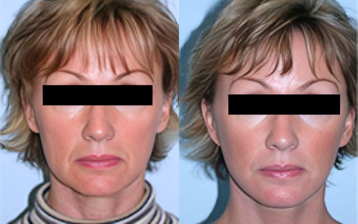 Before & After Facelift Case 2588 View 1 View in Virginia Beach, VA