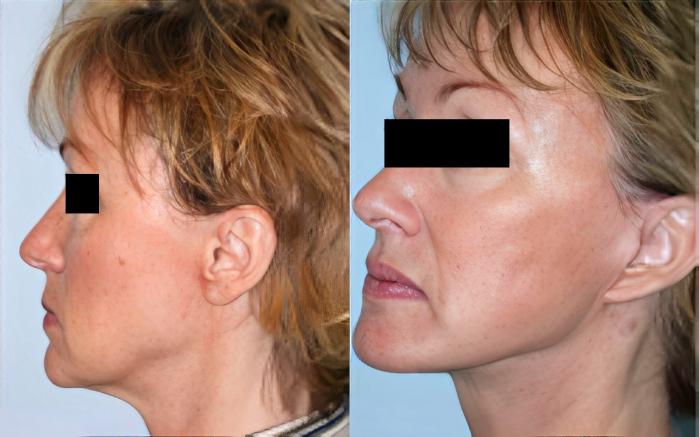 Before & After Facelift Case 2588 View 2 View in Virginia Beach, VA
