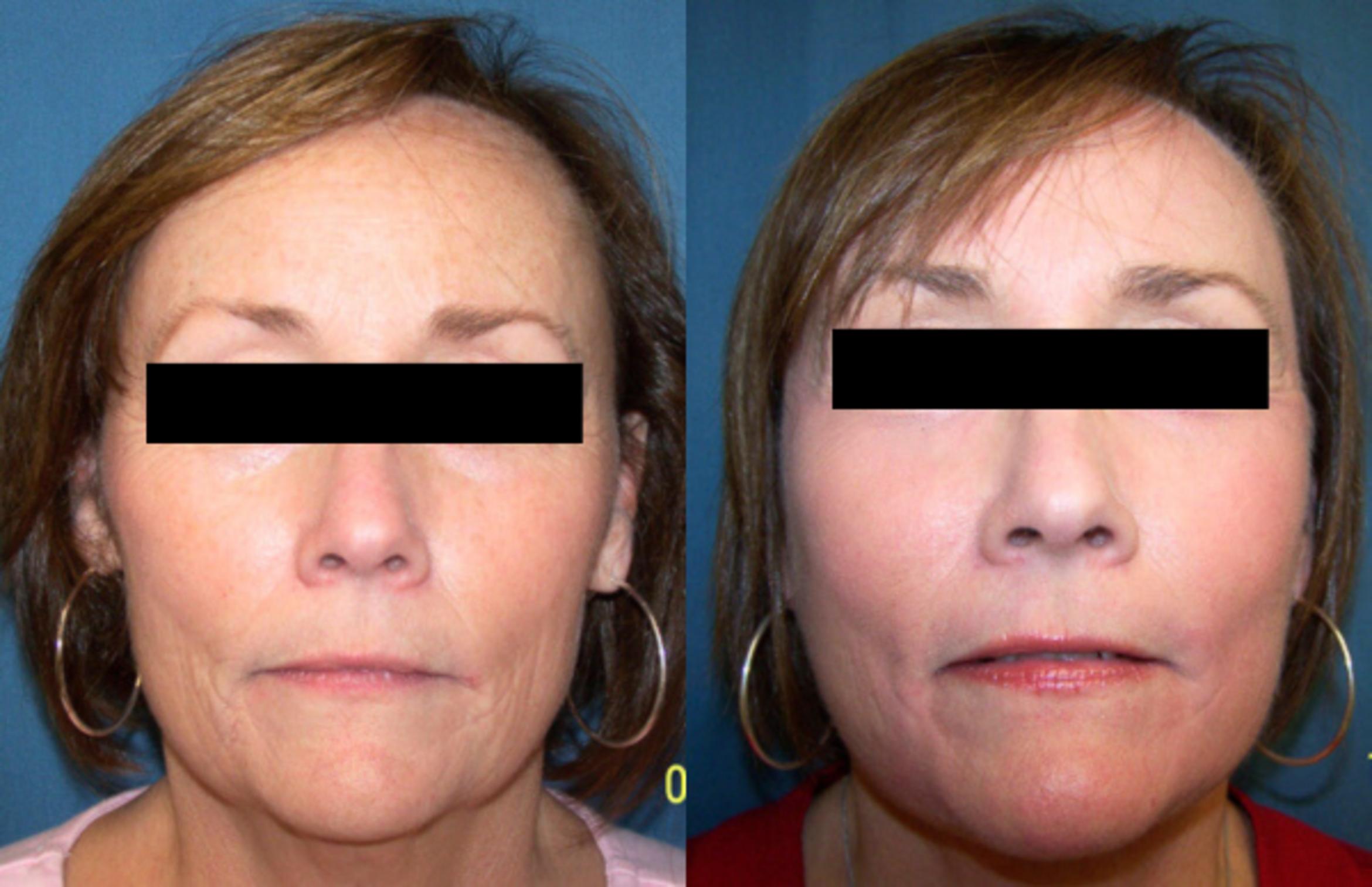 Before & After Facelift Case 2833 View 1 View in Virginia Beach, VA
