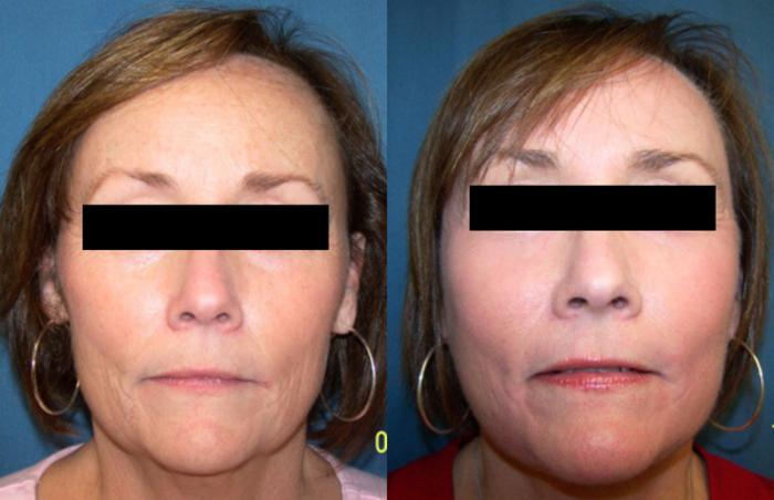 Before & After Facelift Case 2833 View 1 View in Virginia Beach, VA