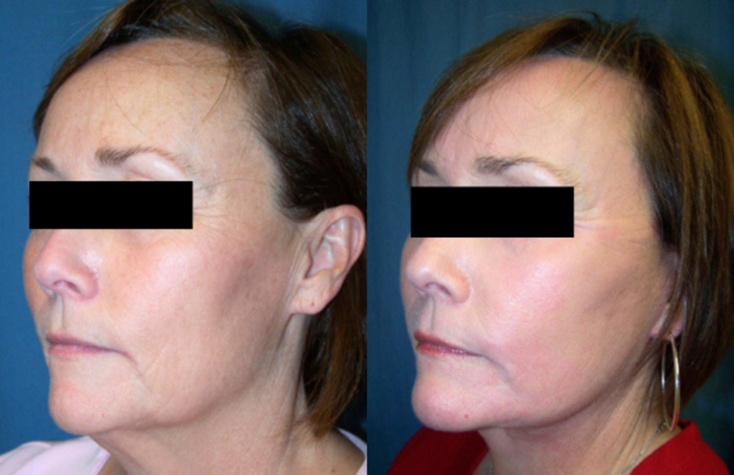 Before & After Facelift Case 2833 View 2 View in Virginia Beach, VA
