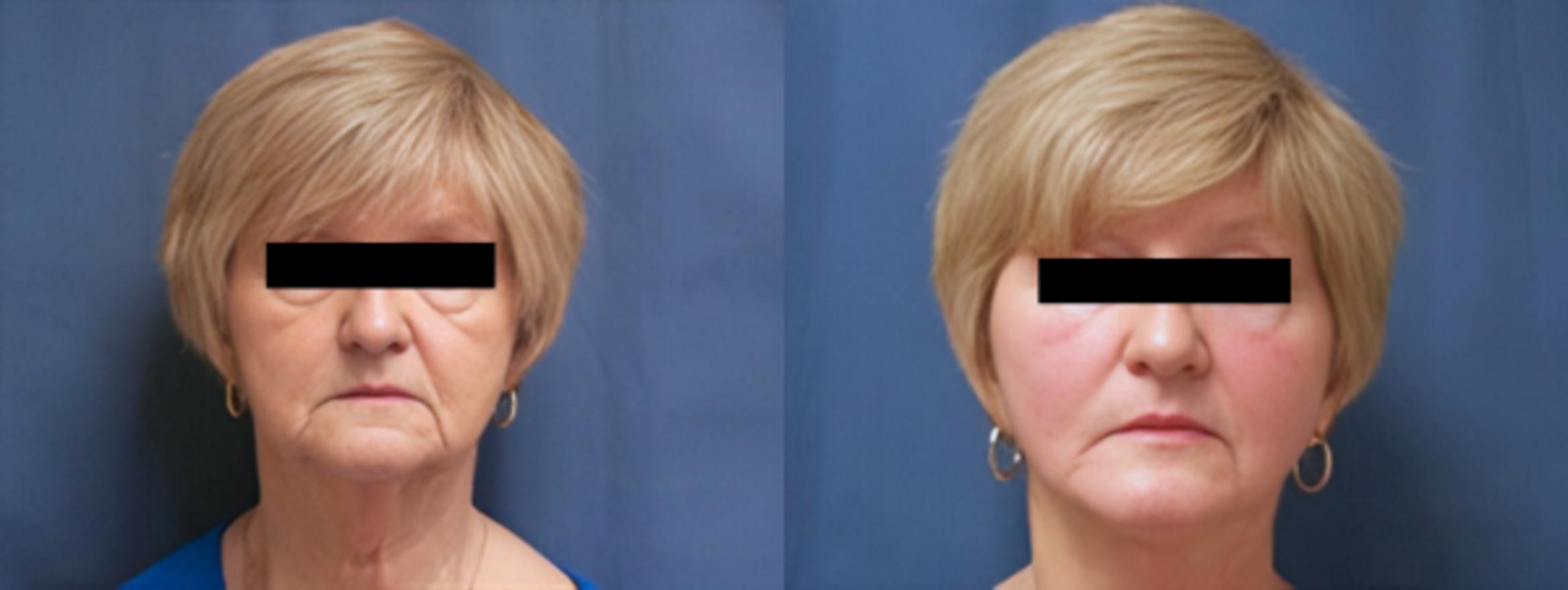 Before & After Facelift Case 3637 View 1 View in Virginia Beach, VA