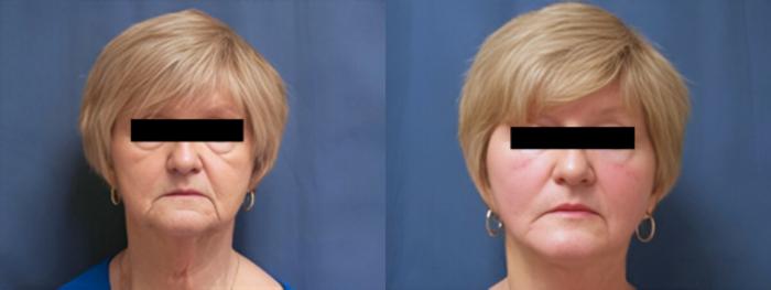 Before & After Facelift Case 3637 View 1 View in Virginia Beach, VA