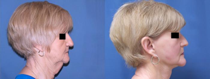 Before & After Facelift Case 3637 View 2 View in Virginia Beach, VA