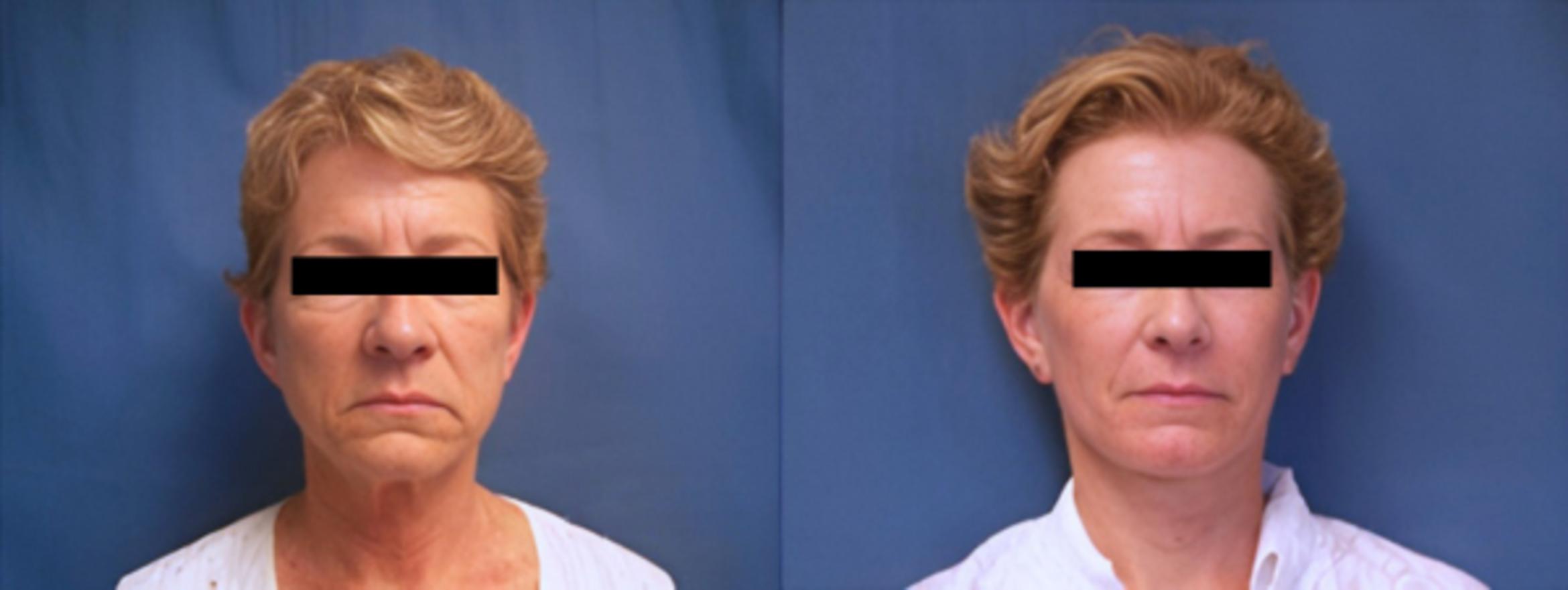 Before & After Facelift Case 3643 View 1 View in Virginia Beach, VA