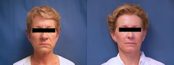 Before & After Facelift Case 3643 View 1 View in Virginia Beach, VA