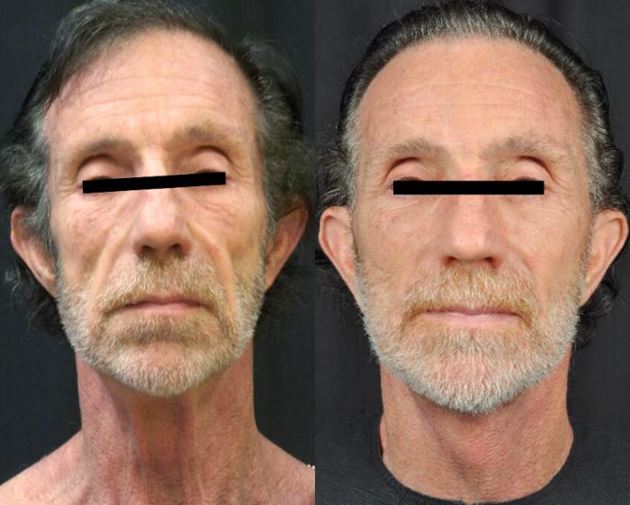 Before & After Facelift Case 4458 View 1 View in Virginia Beach, VA