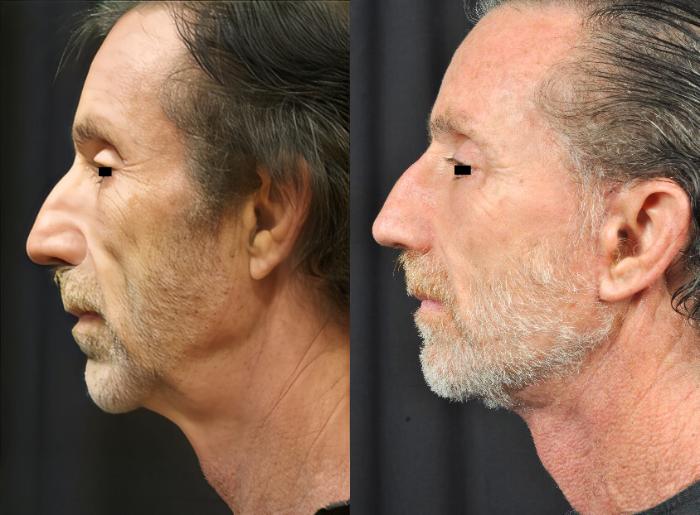 Before & After Facelift Case 4458 View 2 View in Virginia Beach, VA