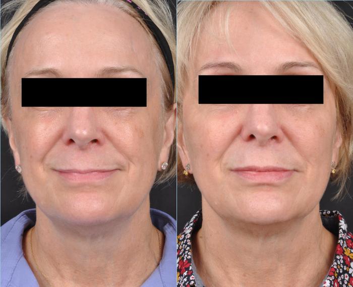 Before & After JUVÉDERM® Volbella Case 19 View 1 View in Virginia Beach, VA
