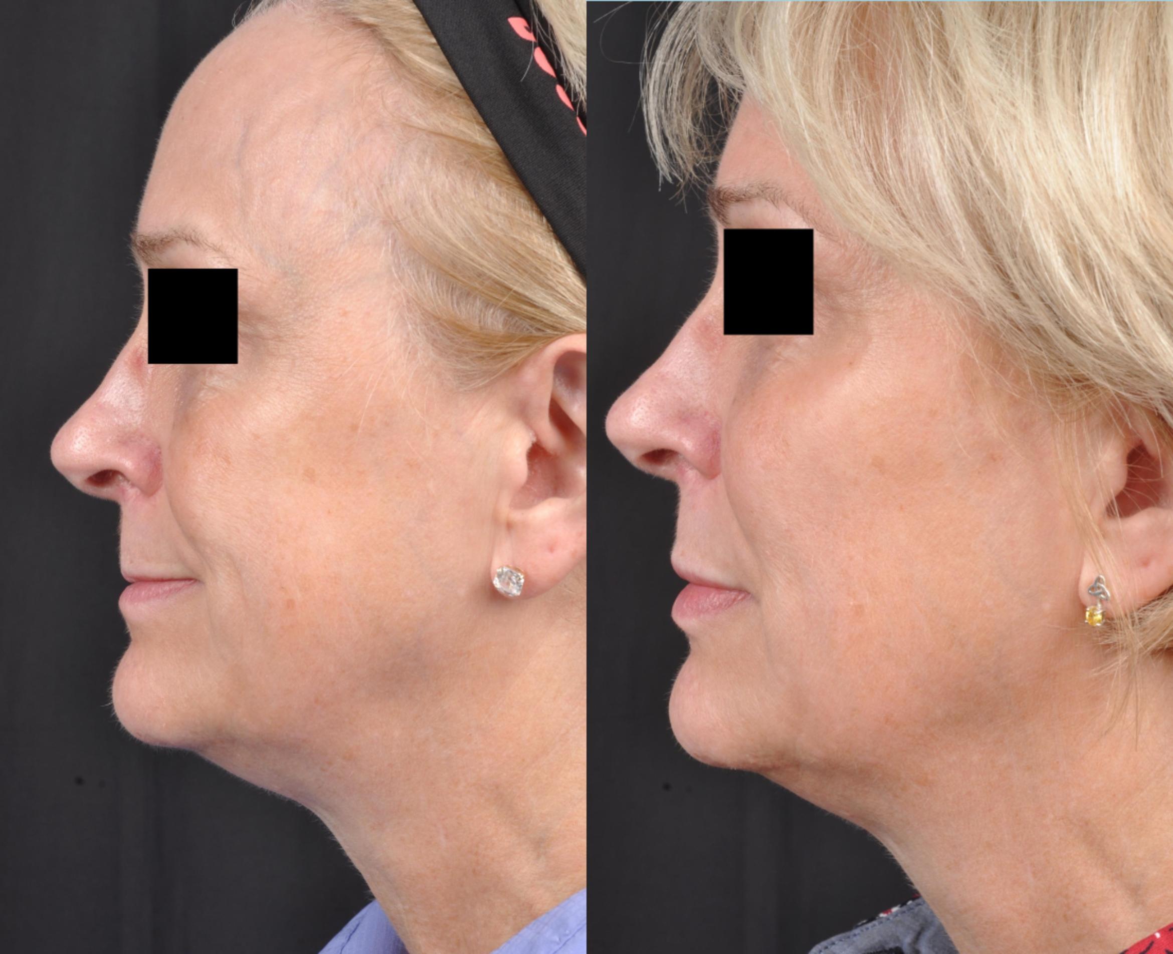 Before & After JUVÉDERM® Volbella Case 19 View 2 View in Virginia Beach, VA