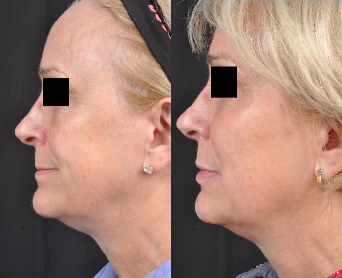 Before & After JUVÉDERM® Volbella Case 19 View 2 View in Virginia Beach, VA