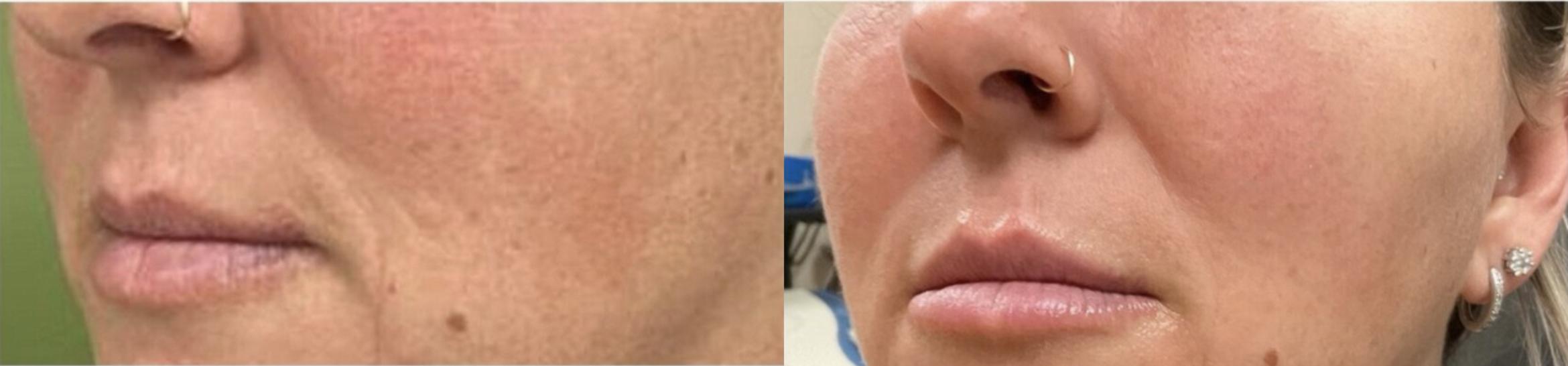 Before & After JUVÉDERM® Volbella Case 22 View 1 View in Virginia Beach, VA