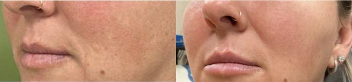 Before & After JUVÉDERM® Volbella Case 22 View 1 View in Virginia Beach, VA