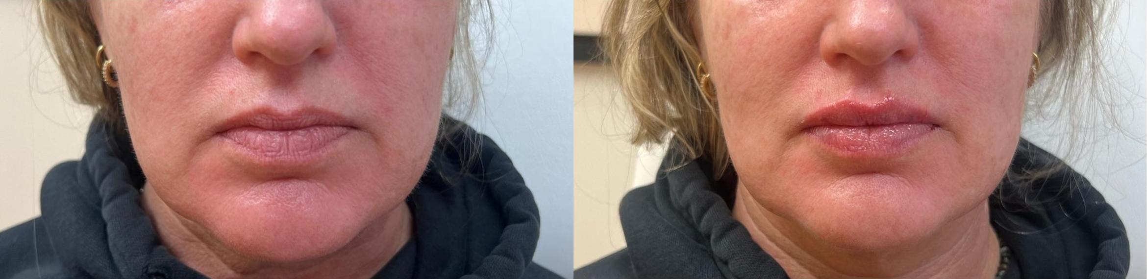 Before & After JUVÉDERM® Volbella Case 60639 Front View in Virginia Beach, VA