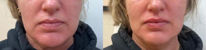 Before & After JUVÉDERM® Volbella Case 60639 Front View in Virginia Beach, VA
