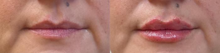 Before & After JUVÉDERM® Volbella Case 60640 Front View in Virginia Beach, VA