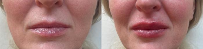 Before & After JUVÉDERM® Volbella Case 60641 Front View in Virginia Beach, VA