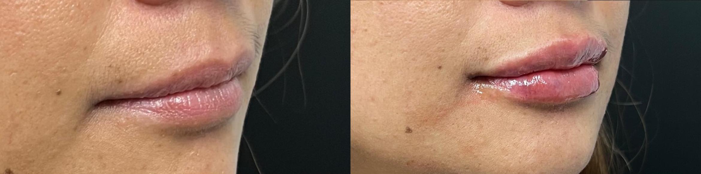Before & After JUVÉDERM® Volbella Case 60642 Front View in Virginia Beach, VA