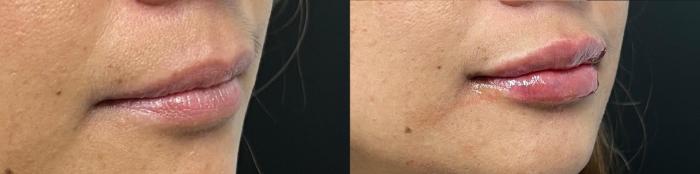Before & After JUVÉDERM® Volbella Case 60642 Front View in Virginia Beach, VA
