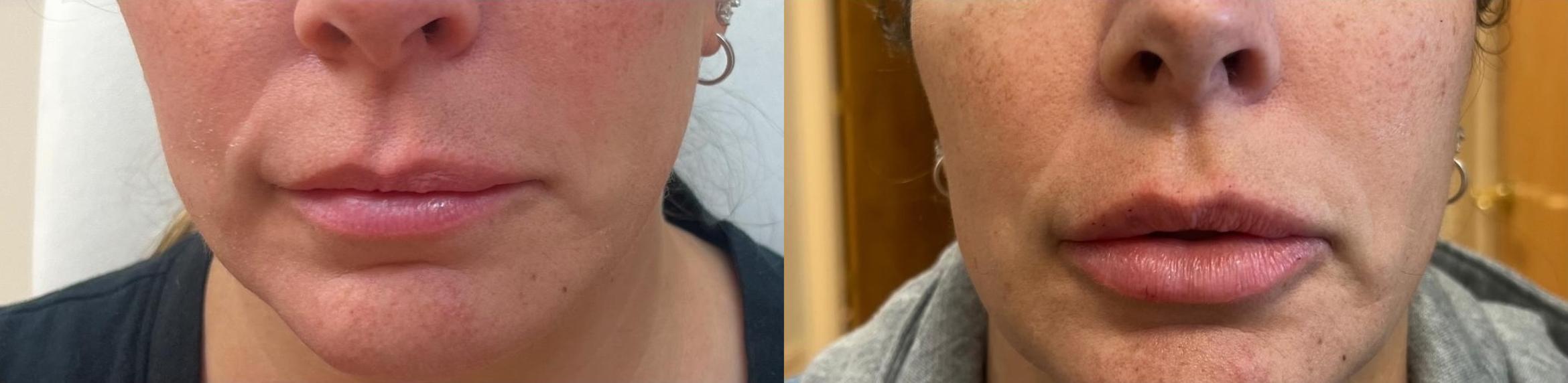 Before & After JUVÉDERM® Volbella Case 60644 Front View in Virginia Beach, VA