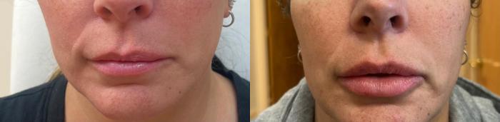 Before & After JUVÉDERM® Volbella Case 60644 Front View in Virginia Beach, VA
