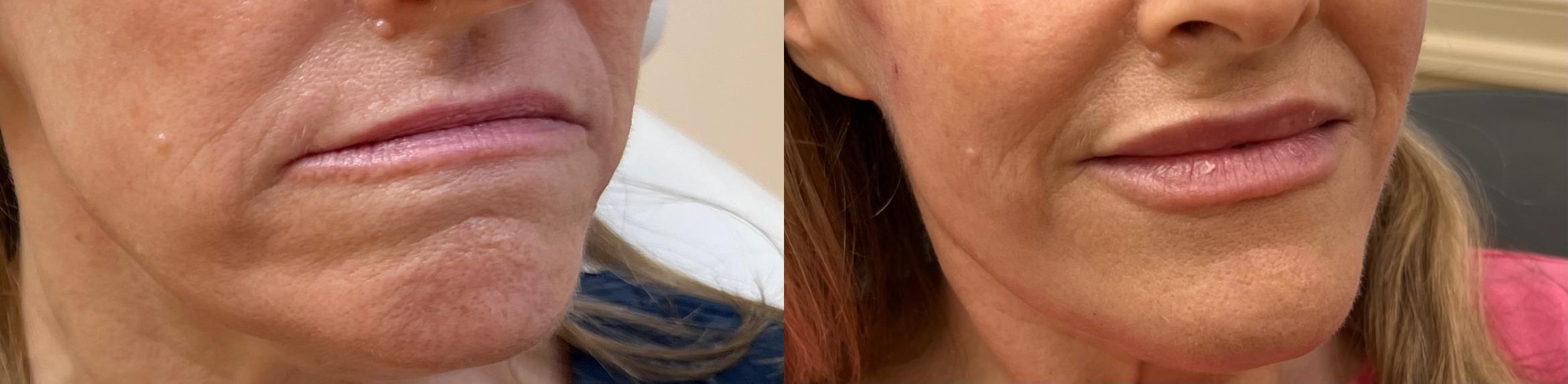 Before & After JUVÉDERM® Volbella Case 60646 Front View in Virginia Beach, VA