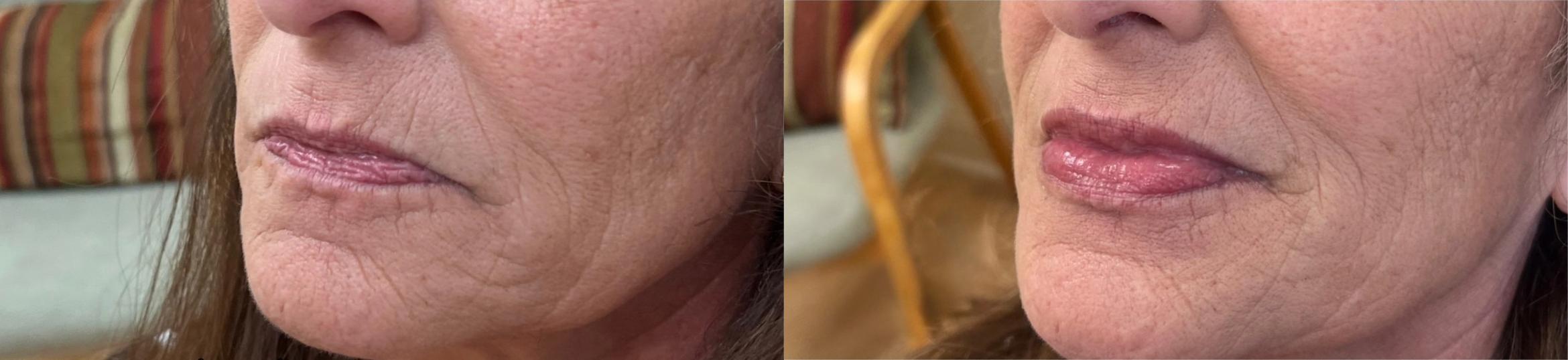 Before & After JUVÉDERM® Volbella Case 60666 Three-quarter view (right) View in Virginia Beach, VA