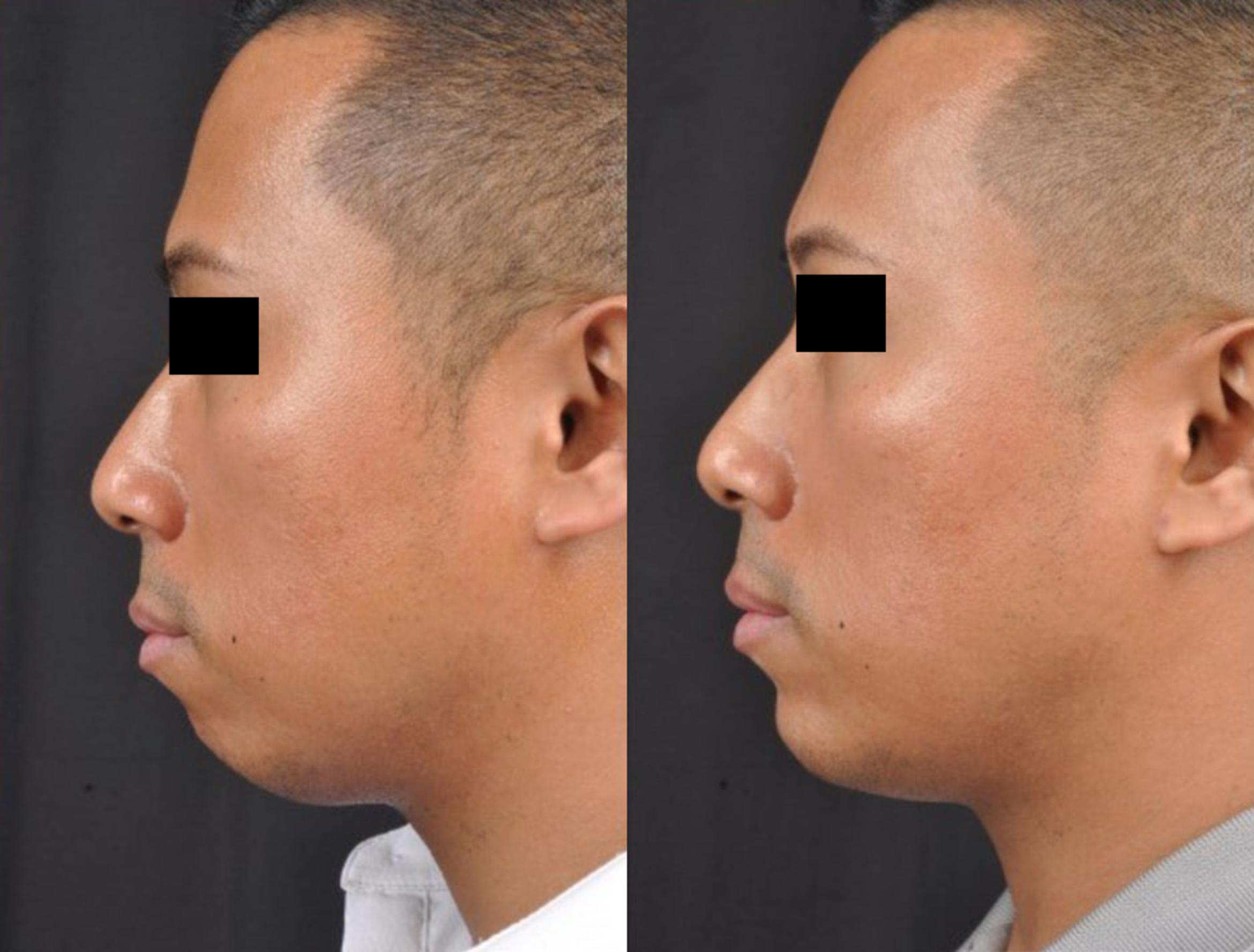 Before & After JUVÉDERM® Voluma Case 27524 View 1 View in Virginia Beach, VA