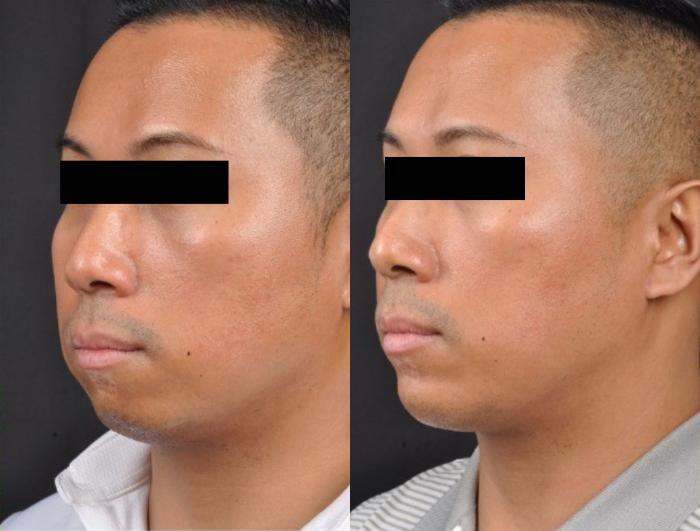 Before & After JUVÉDERM® Voluma Case 27524 View 2 View in Virginia Beach, VA