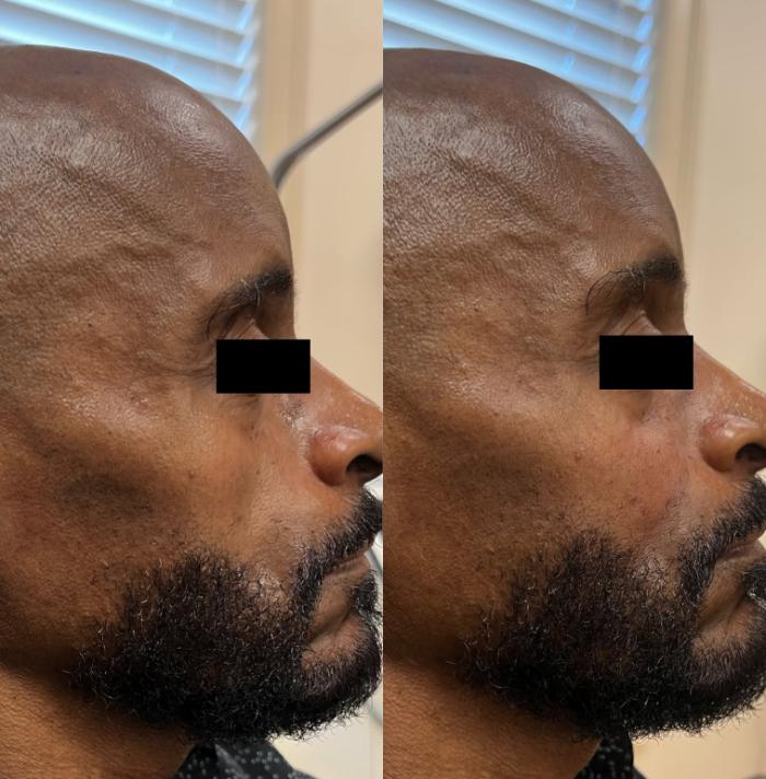 Before & After JUVÉDERM® Voluma Case 60650 Left Side View in Virginia Beach, VA
