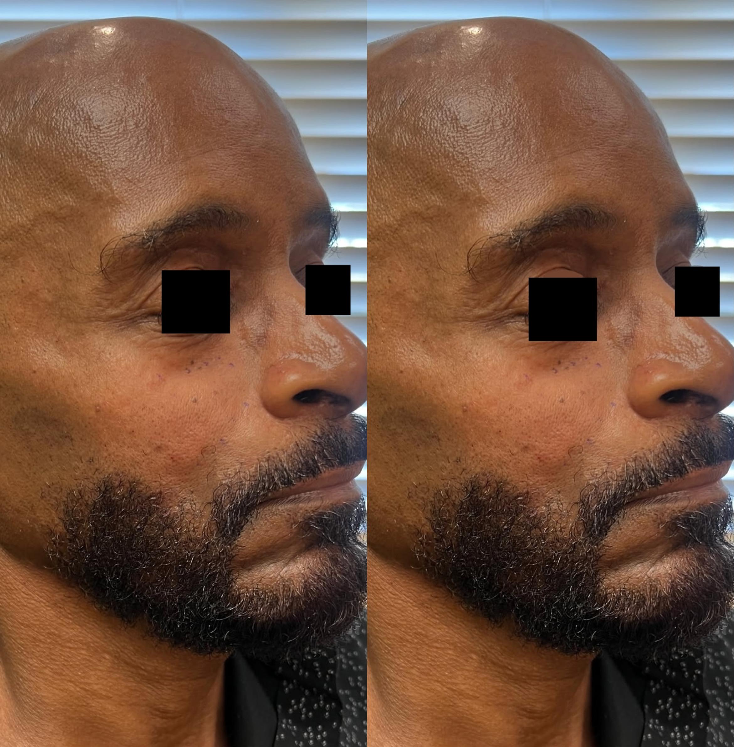 Before & After JUVÉDERM® Voluma Case 60650 Three-quarter (left) View in Virginia Beach, VA