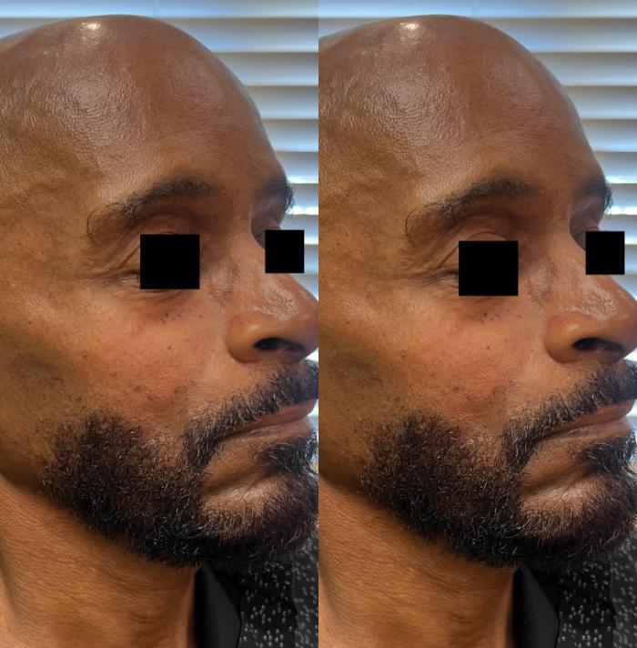 Before & After JUVÉDERM® Voluma Case 60650 Three-quarter (left) View in Virginia Beach, VA