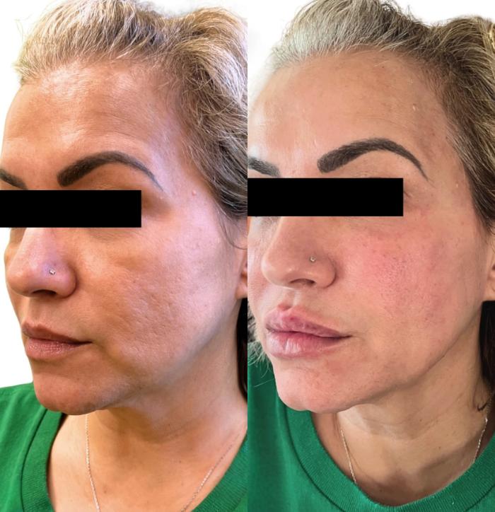 Before & After JUVÉDERM® Voluma Case 60662 Right Side View in Virginia Beach, VA