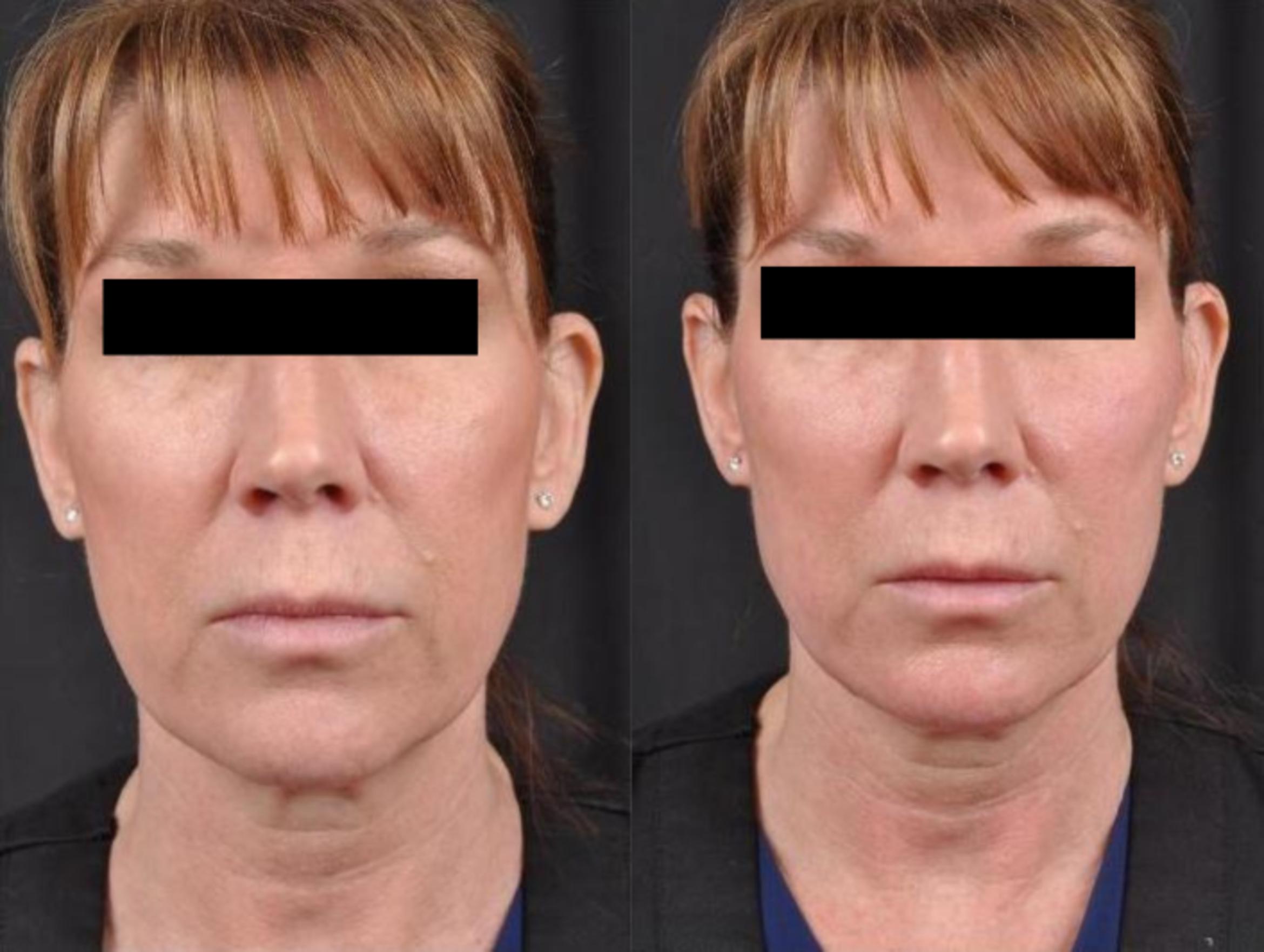 Before & After JUVÉDERM® Volux Case 23 View 1 View in Virginia Beach, VA