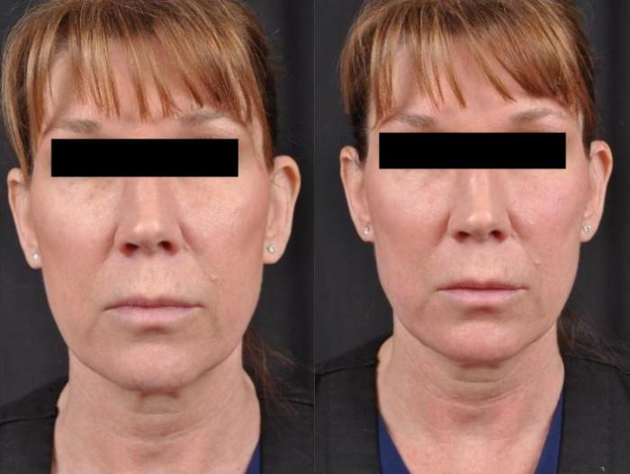 Before & After JUVÉDERM® Volux Case 23 View 1 View in Virginia Beach, VA
