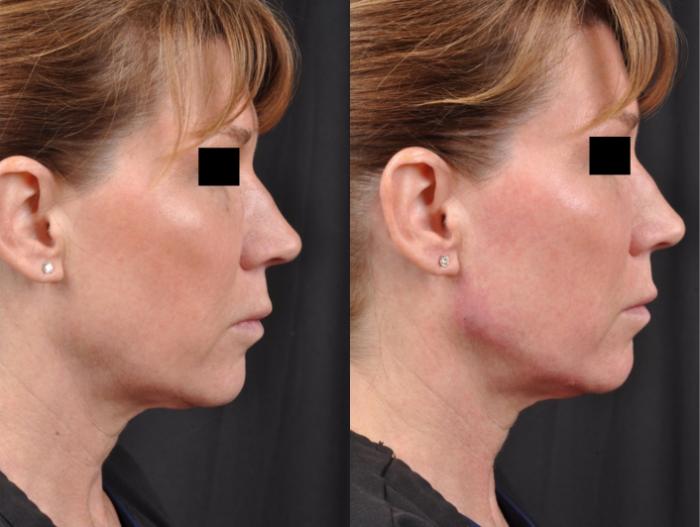 Before & After JUVÉDERM® Volux Case 23 View 2 View in Virginia Beach, VA