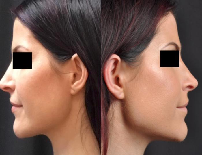 Before & After JUVÉDERM® Volux Case 24 View 1 View in Virginia Beach, VA