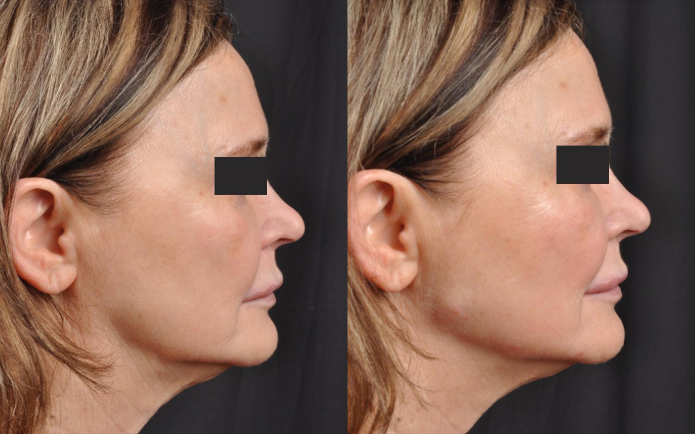 Before & After JUVÉDERM® Volux Case 25 View 1 View in Virginia Beach, VA