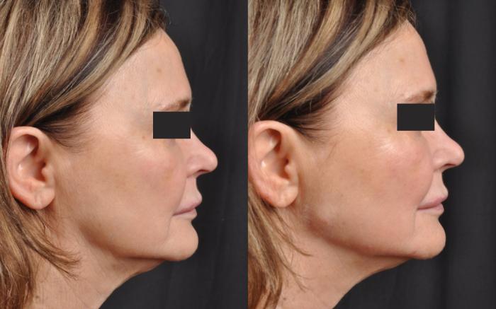 Before & After JUVÉDERM® Volux Case 25 View 1 View in Virginia Beach, VA