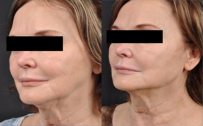 Before & After JUVÉDERM® Volux Case 25 View 2 View in Virginia Beach, VA