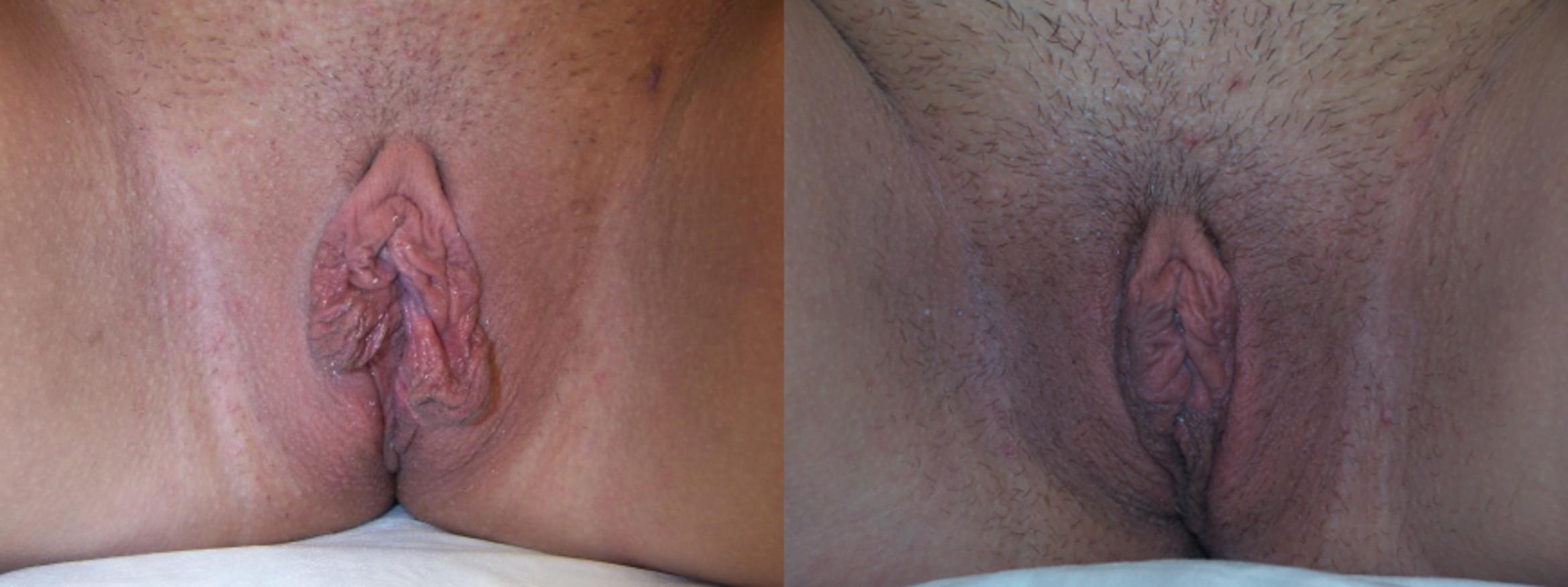 Before & After Labiaplasty Case 3269 View 1 View in Virginia Beach, VA